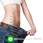 Liposuction Belly
