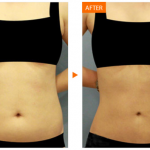 ดูดไขมัน12