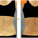 ดูดไขมัน14