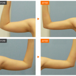 ดูดไขมันแขน2