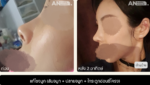 AND_Nose_beforeafter_3